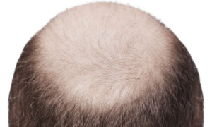 can masturbating cause hair loss