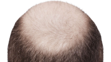 can masturbating cause hair loss